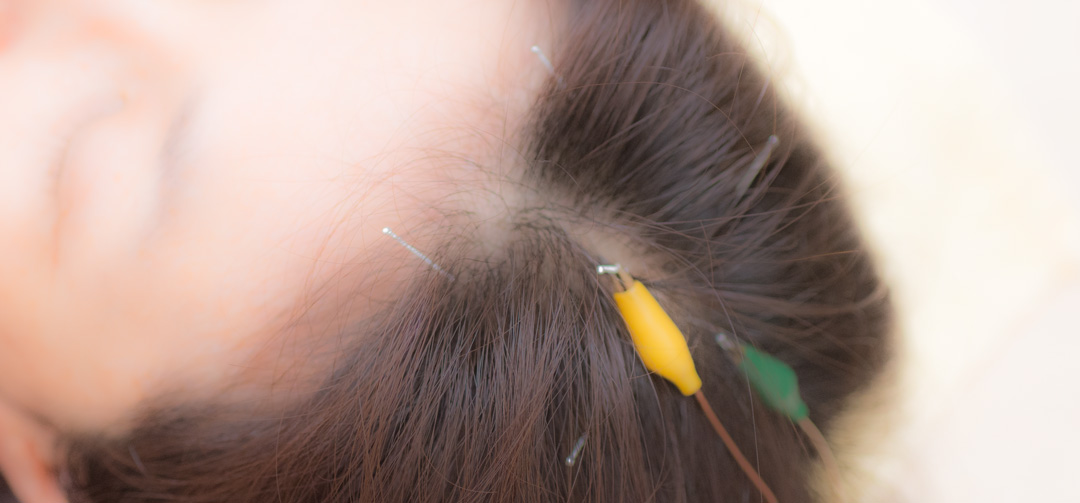 頭の経穴への鍼治療
